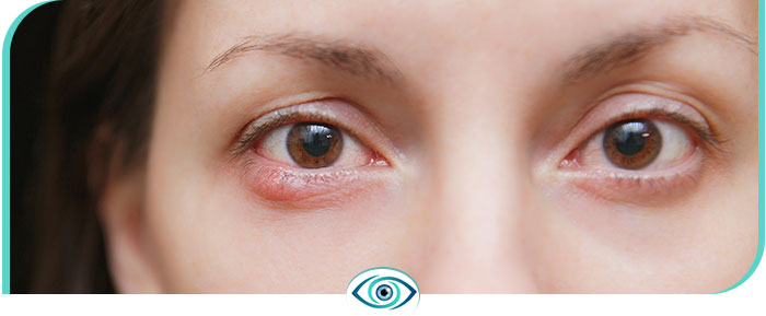 Blepharitis Treatment in Nicetown, CA 
